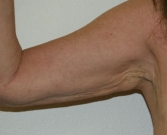 Feel Beautiful - Arm reduction San Diego Case 4 - Before Photo